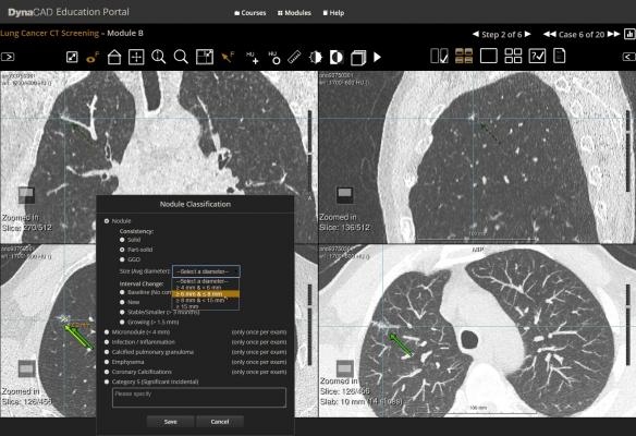 SBRT Offers Curative Option for Lung Cancer Patients 80 and